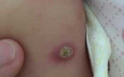 婴儿打完疫苗后红肿有脓-婴儿打过疫苗后肿脓包