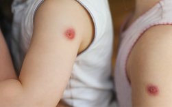  打疫苗的疤红肿「打疫苗的疤红肿了怎么办」