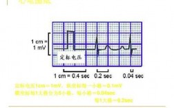 心电图机1mv什么意思,心电图1s等于多少ms 