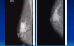 钼靶乳腺为什么要用软x射线