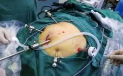 腹腔镜手术用什么切割好 腹腔镜手术用什么切割