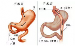  胃转流和肠转流哪个效果好「胃肠转流手术对人的伤害」