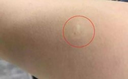  胳膊上有疤的疫苗「胳膊上有疤的疫苗叫什么」