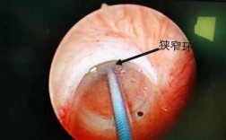 球囊扩张导管用于什么手术 球囊扩张导管什么手术