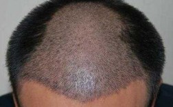 广州植发的价格一般是多少 广州种植头发询新生效果好