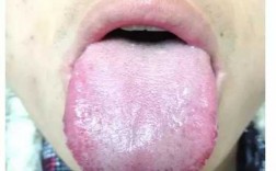 舌头疾病哪种治疗效果好,舌头毛病 