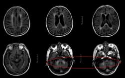 磁共振脑部白色代表什么,脑部磁共振白色区域 