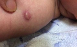  婴儿打水痘疫苗后化脓「婴儿打水痘疫苗后化脓了」
