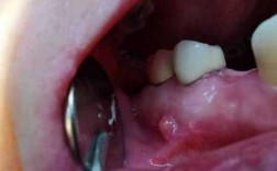 牙齿瘘管有些什么最好治疗的办法