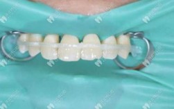 牙用纤维带是什么材料_纤维带固定牙齿的优缺点