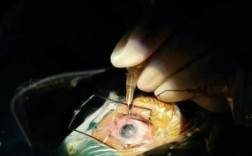 眼底好植入人工晶体的效果（眼睛中植入的人工晶体是什么样子的?）