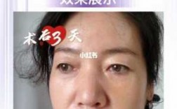  上海哪个医院去眼袋效果好「上海哪家医院去眼袋手术最好」