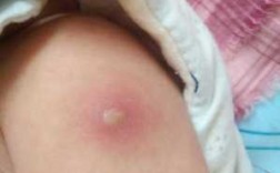 宝宝接种水痘疫苗后手臂有硬结-宝宝打完水痘疫苗胳膊红肿
