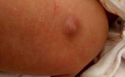 宝宝打疫苗后皮肤里有硬疙瘩