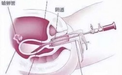 宫腔镜手术中的膨宫介质可选择