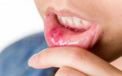 口腔溃疡可否服用疫苗