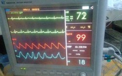 心电监护仪上的指标是什么,心电监护仪指示 