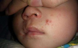  宝宝打疫苗起水痘吗「宝宝打疫苗起水痘吗图片」
