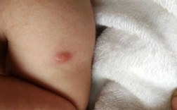 婴儿打疫苗后皮肤_婴儿打疫苗后皮肤发黄