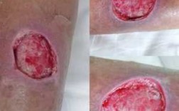 什么是无菌伤口,什么是无菌伤口和感染伤口 