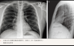 新型冠状肺炎胸片呈什么样_新型冠状病毒肺炎胸片表现
