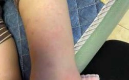  打完水痘疫苗脚上出疹子「打水痘疫苗后脚长很多小红点」