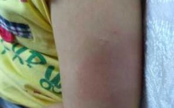 宝宝周岁打疫苗红肿_一岁小孩打防疫针后有硬块红肿