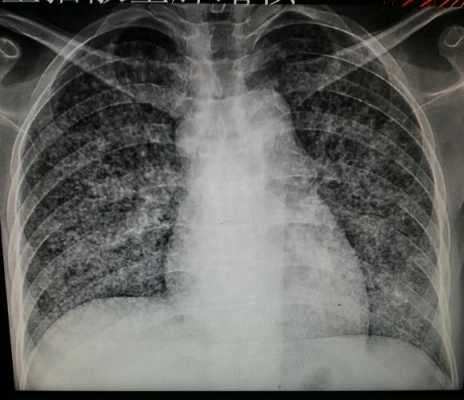 新型冠状肺炎胸片呈什么样_新型冠状病毒肺炎胸片表现-图3