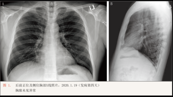 新型冠状肺炎胸片呈什么样_新型冠状病毒肺炎胸片表现-图1