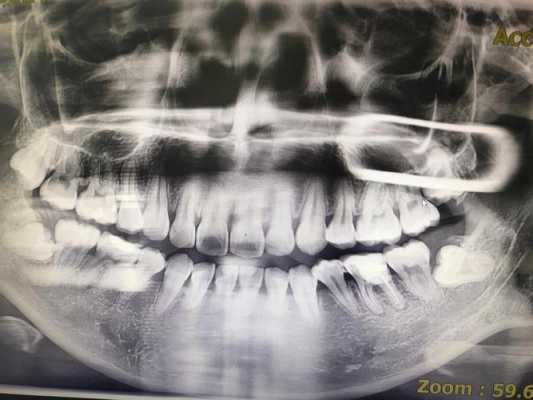 口腔牙片中心射线是什么,牙片射线含量多少 -图1