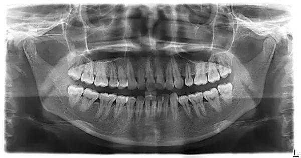 口腔牙片中心射线是什么,牙片射线含量多少 -图2