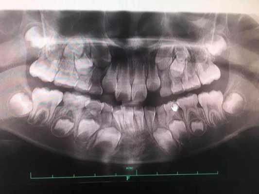 口腔牙片中心射线是什么,牙片射线含量多少 -图3