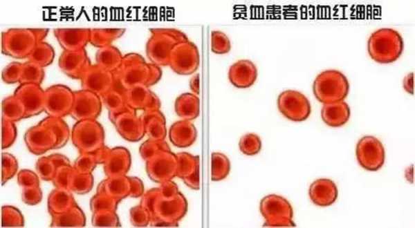 红细胞50ul什么意思_红细胞50严重吗-图3