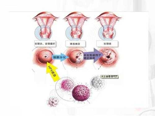 宫颈疫苗卵巢囊肿手术,宫颈疫苗卵巢囊肿手术后能打吗 -图2