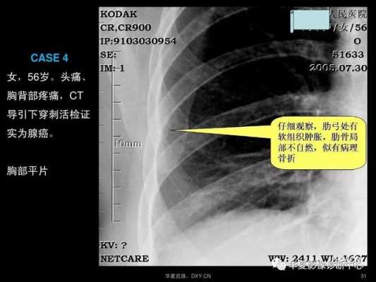 关于x胸片与ct那个效果好的信息-图1