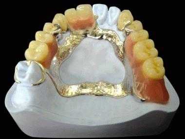什么是定制式义齿牙套-图3
