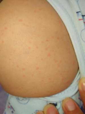 打完疫苗宝宝身上起红疹子怎么办-打完疫苗宝宝身上起红疹-图2