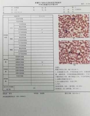 全血细胞分析是检查什么病的 全血细胞分析是检查什么-图3