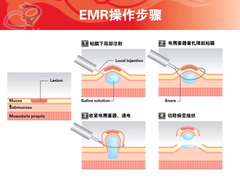粘膜切开刀是什么,黏膜切除术emr -图2