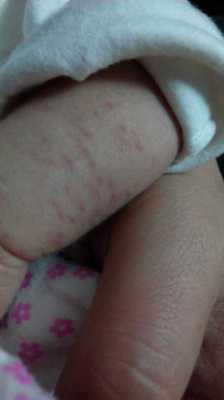 婴儿疫苗后红疹-婴儿种疫苗后红斑图片-图2