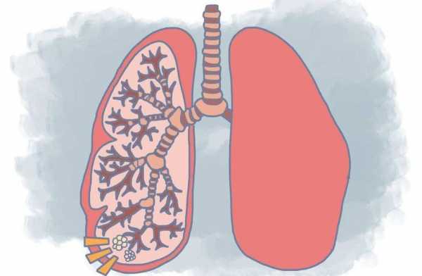 肺朗有什么症状,肺肺病症状表现有哪些 -图3