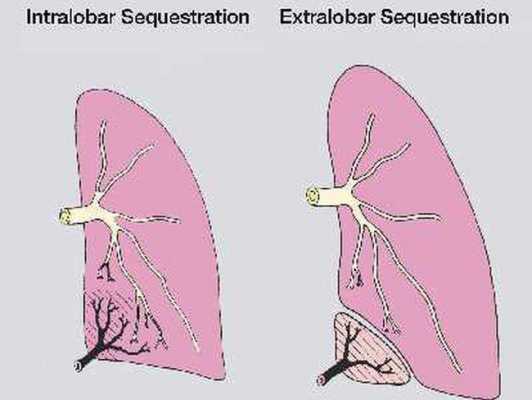 肺部检查as是什么意思-图2