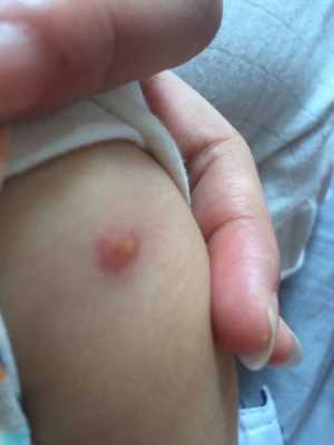 宝宝打疫苗后皮肤里有硬疙瘩-图2