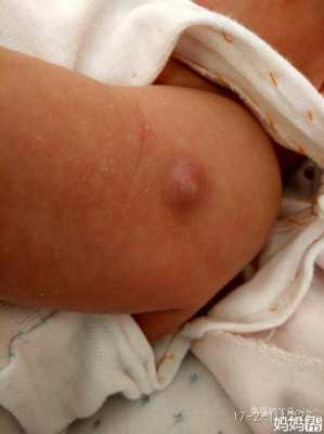 宝宝打疫苗后皮肤里有硬疙瘩-图1