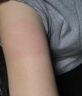 打完疫苗手臂红肿发烫-打疫苗后手臂红肿热-图1