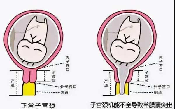 宫颈口软化与宫口开指有什么关系-图3