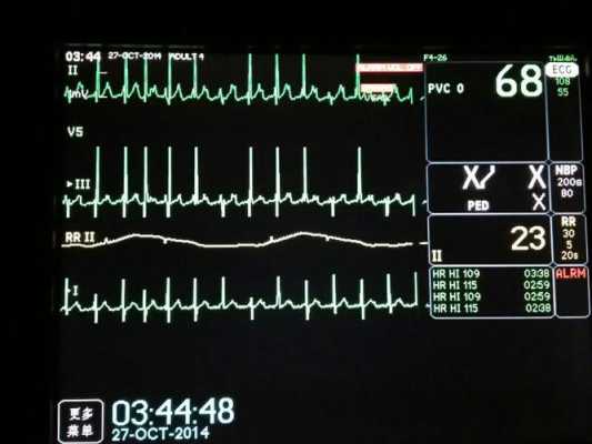 心电监护的ecg什么意思,心电监护仪ecg正常值 -图1
