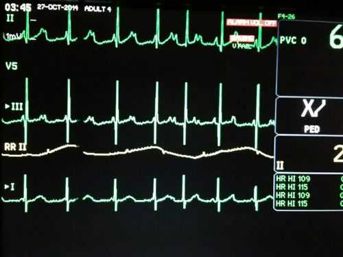 心电监护的ecg什么意思,心电监护仪ecg正常值 -图2