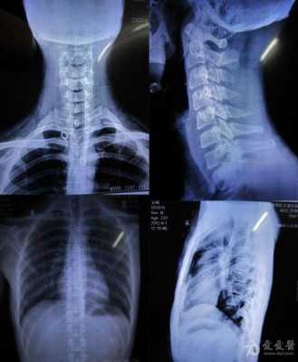 脊椎有问题拍什么片子-脊椎病拍啥片效果好-图2