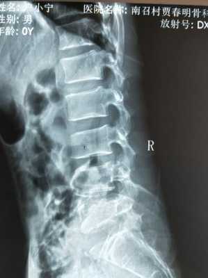 脊椎有问题拍什么片子-脊椎病拍啥片效果好-图1